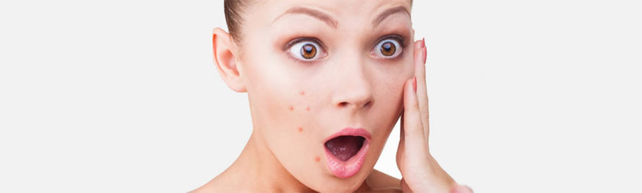 Top 5 things to Avoid when Managing Acne and Congested Skin
